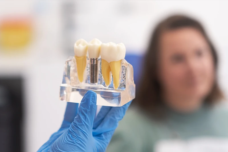 Implantes dentarios