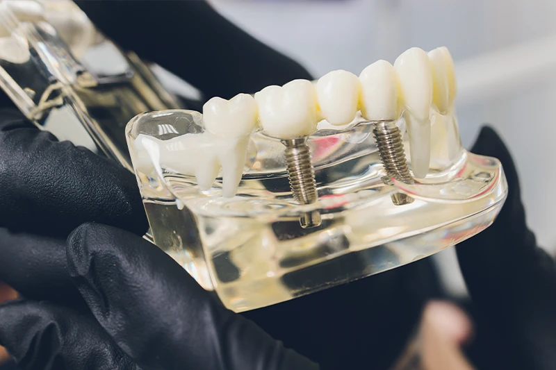 implantes dentarios Joinville