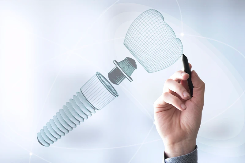 Implantes Dentários - Mitos e Verdades