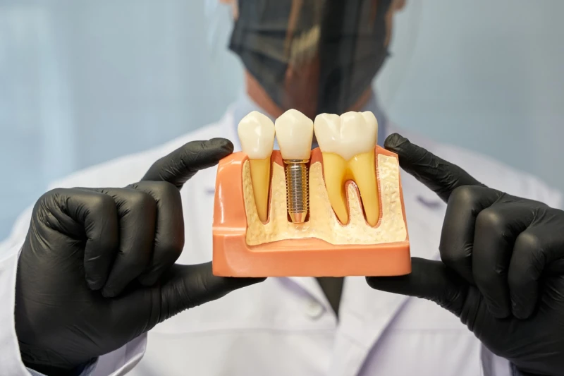 curiosidades-sobre-implantes-dentarios