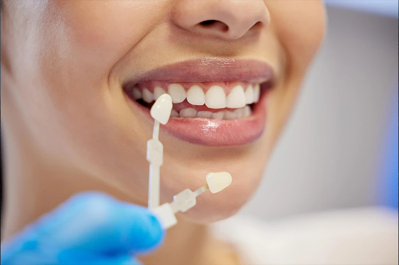 Clareamento Dental - Como a Sorrisus Joinville